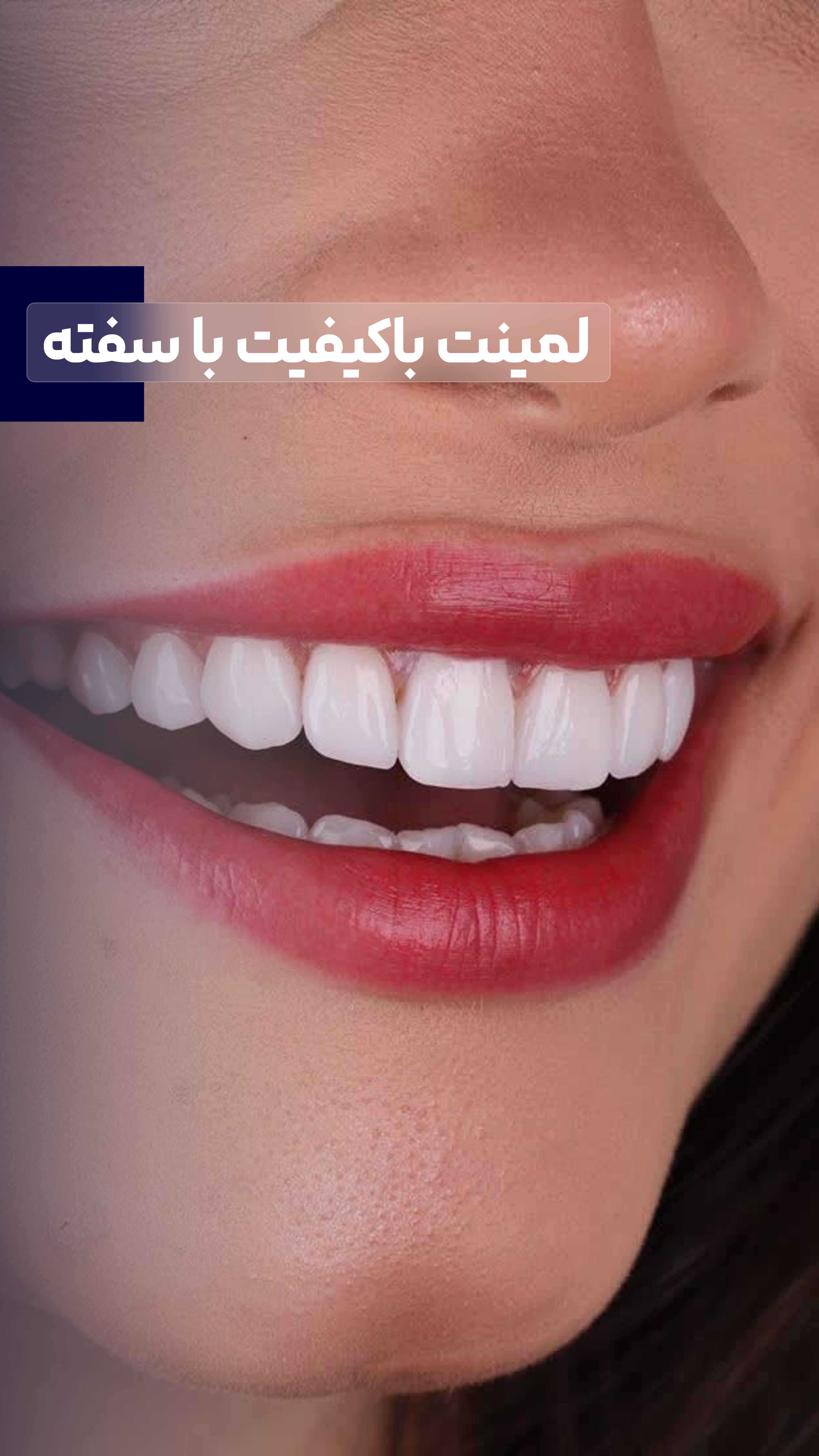 لمینت